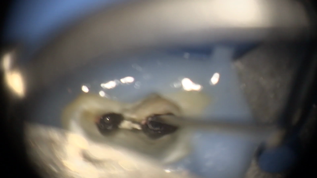 歯の神経の治療。【動画】顕微鏡を使って再根管治療。の記事動画