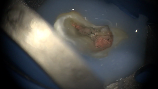歯の神経の治療。【動画】顕微鏡を使って再根管治療。の記事動画