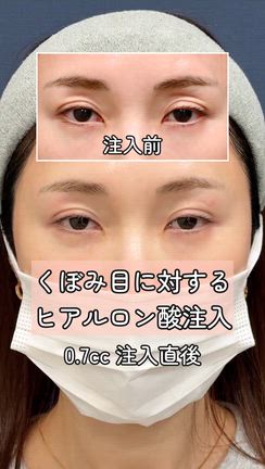 【くぼみ目治療】 程よくボリュームを足して印象改善の記事動画