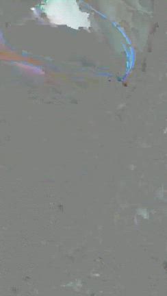 【眉下切開＋ROOF切除】上まぶたのたるみと厚みを解消の記事動画