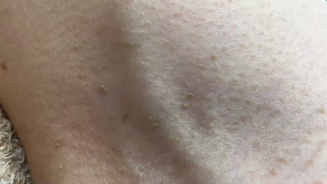 スタッフの首のイボを治療しましたの記事動画