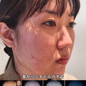 【肌管理Vlog】毛穴・ニキビ跡治療の経過大公開（キュアジェット＆エアサブシジョン）の画像