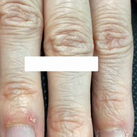 長年の噛み爪をどうにかしたい！の画像