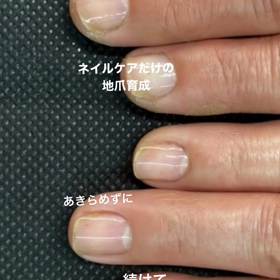 金属アレルギーで爪が変形！の画像