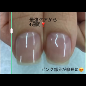 この効果☆4週間でピンク部分が伸びてます！の画像