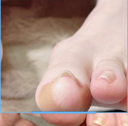巻き爪の痛みどうしたらなくなる？の記事動画