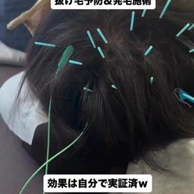 育毛鍼の画像