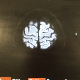 脳梗塞部位の画像