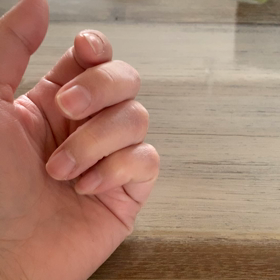 ばね指の画像