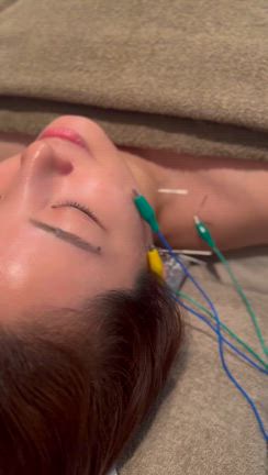 初めての美容鍼の記事動画