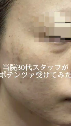 ポテンツァの施術から症例写真をご紹介！の記事動画