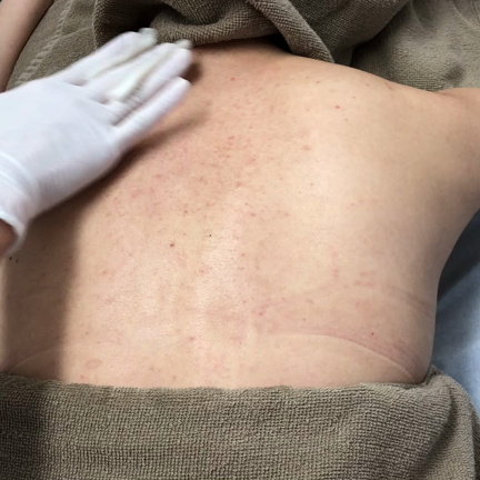 背中のミルクピール、キャンペーンしています！の記事動画