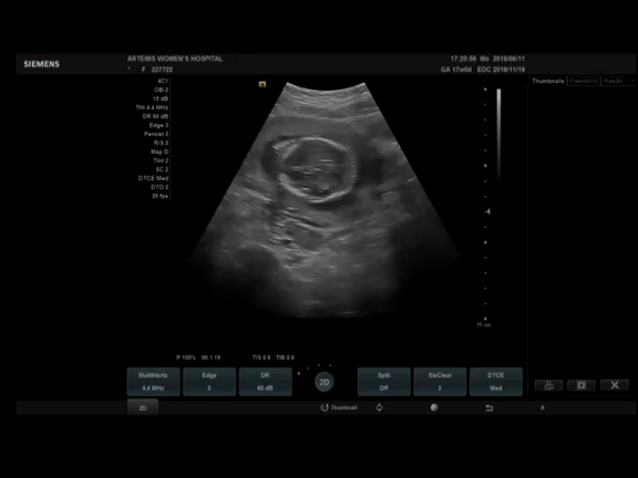 17w0d 性別判明 2dエコー動画 成長記録