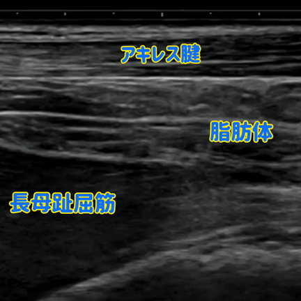 太いふくらはぎの本当の原因！【エコー検査で分かった】細いふくらはぎと何が違う?の記事動画