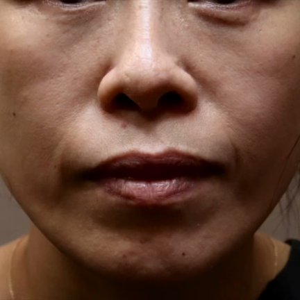 美容皮膚科的な治療って必要ですか？の記事動画