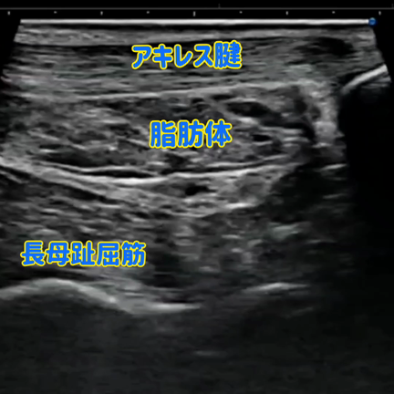 太いふくらはぎの本当の原因！【エコー検査で分かった】細いふくらはぎと何が違う?の記事動画