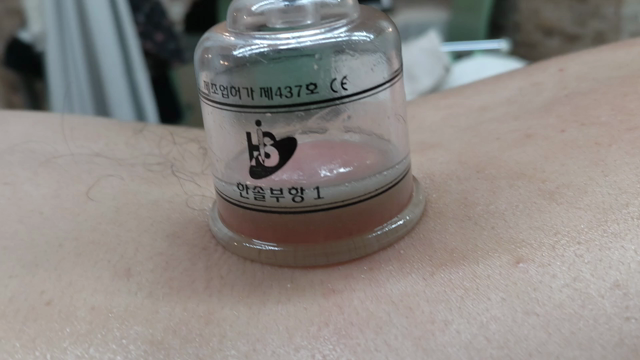 スライドカッピングでドロドログレー色の排毒の記事動画