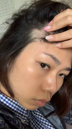 円形脱毛症は繰り返す？！の記事動画