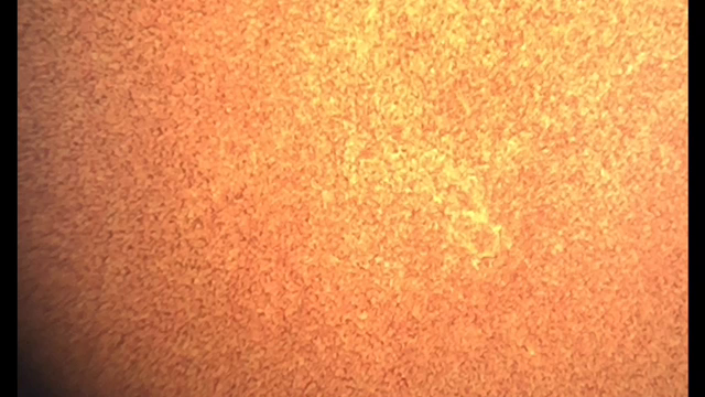 注射器扱いすぎてマメできた理由は？フィラリア症の記事動画