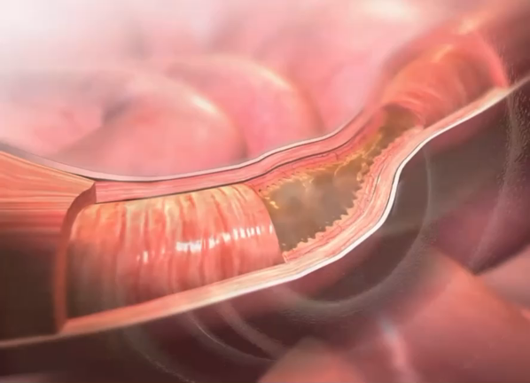 豊胸でシリコンを入れた女性の50％がシリコンを取り除く？？の記事動画