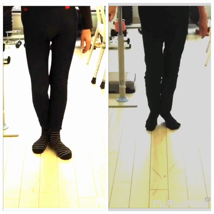 変形性股関節症における施術とリハビリによる効果の記事動画