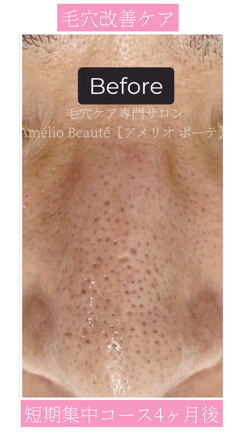 鼻の凸凹、開き毛穴、毛穴の肥大化が変わりました(^^)の記事動画