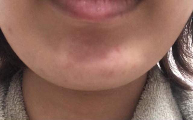 顎の梅干しシワ撃退！の記事動画