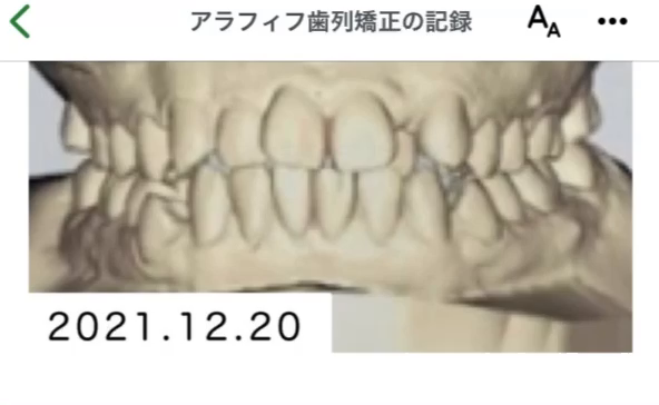 歯科矯正の写真記録の記事動画