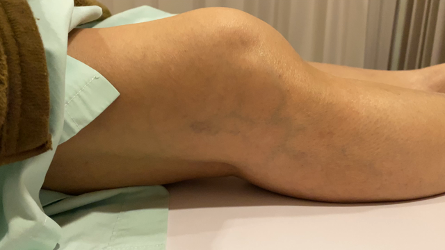 手術が決まっていた重度の変形性膝関節症が回復、その『新しい』手法とは？の記事動画