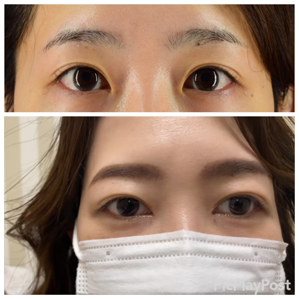 目頭切開を考える② 〜やりすぎちゃいかんのよ〜　（改訂版）の記事動画