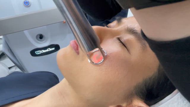 新機器「ウルトラクリアレーザー」とは？の記事動画