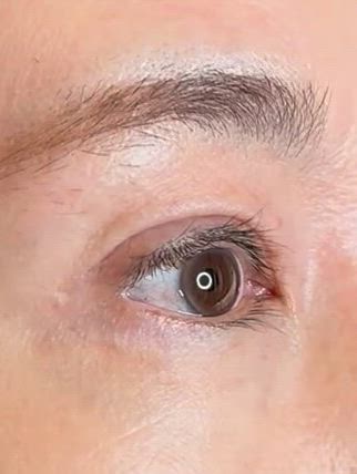 50代の初回眼瞼下垂　の記事動画