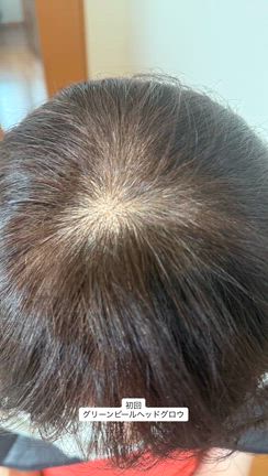 頭皮トラブルや薄毛には“グリーンピールヘッドグロウ”の記事動画