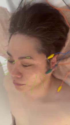 美容鍼の記事動画