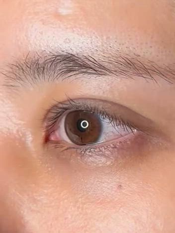 過矯正•外反•強い食い込み•幅広二重の修正の記事動画