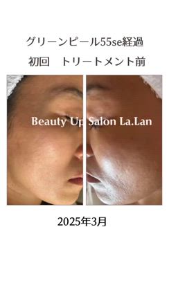 グリーンピール55sec  経過〜40代のお客様〜の記事動画