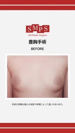 【韓国SM整形外科】豊胸手術の症例紹介！ビフォーアフターをチェックの記事動画