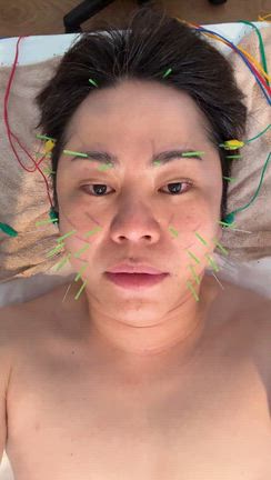 美容鍼の記事動画