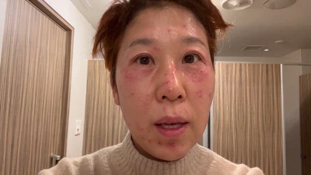 ピコスポットしてきました！全顔シミ取り体験記！の記事動画