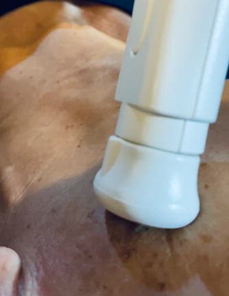 【プラズマフェイシャル】肌質改善・シミケアコース院長体験（画像あり）の記事動画