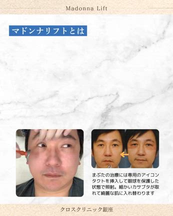 マドンナリフト｜まぶたのたるみ・毛穴・ニキビ跡の記事動画