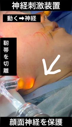 神経刺激装置の実際　フェイスリフトのリガメント処置の記事動画