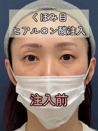 【くぼみ目ヒアル】くぼみ目をヒアルロン酸で治すメリットの記事動画