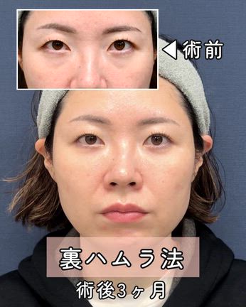 【裏ハムラ】「笑うと2段」のクマはハムラ法が最適解！の記事動画