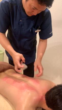 カッピングでデトックス！肩こりにはこれ！！の記事動画