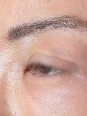 50代　初回の眼瞼下垂の記事動画