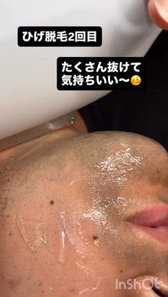 ひげ脱毛２回目リールの記事動画