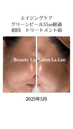 ホームケアなし！グリーンピール55secの経過の記事動画