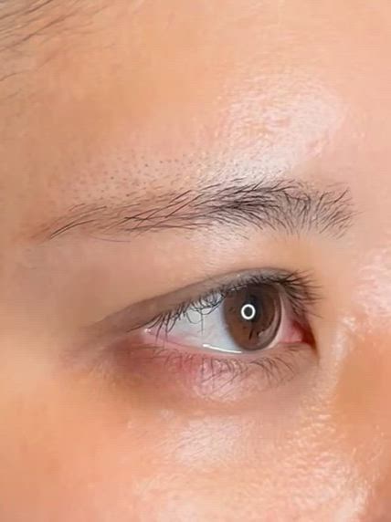 過矯正•外反•強い食い込み•幅広二重の修正の記事動画