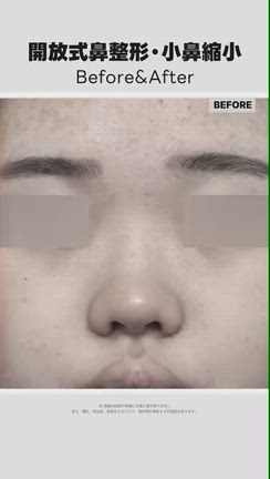鼻(フル)＋小鼻縮小の記事動画